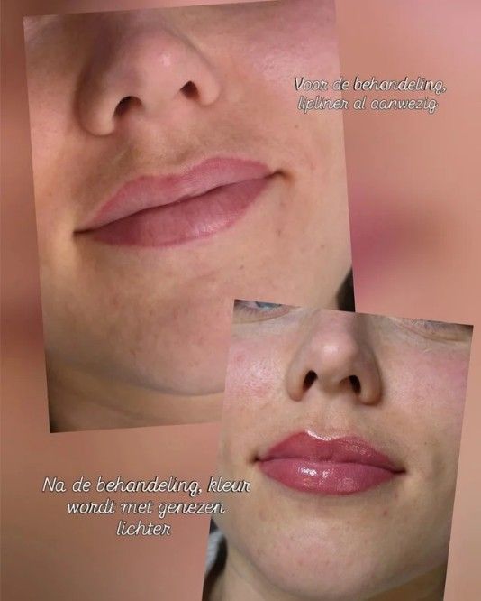 Lippen voor en na de behandeling, met Petra's eigen bijschrift